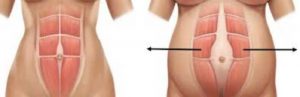 diastasis-abdominal