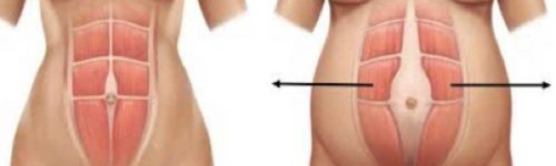 diastasis-abdominal